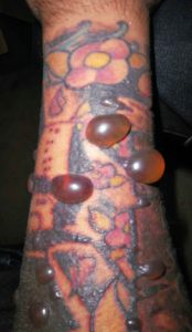 reaccion alergica tatuaje tinta